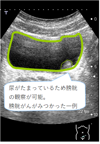 お小水をためて検査を受ける理由は 巣鴨駅前胃腸内科クリニック