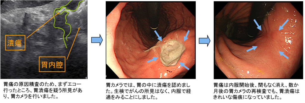 胃潰瘍（診断）