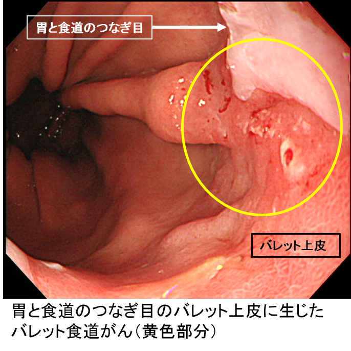 食道がん・胃がん・大腸がんの早期発見・予防外来 巣鴨駅前胃腸