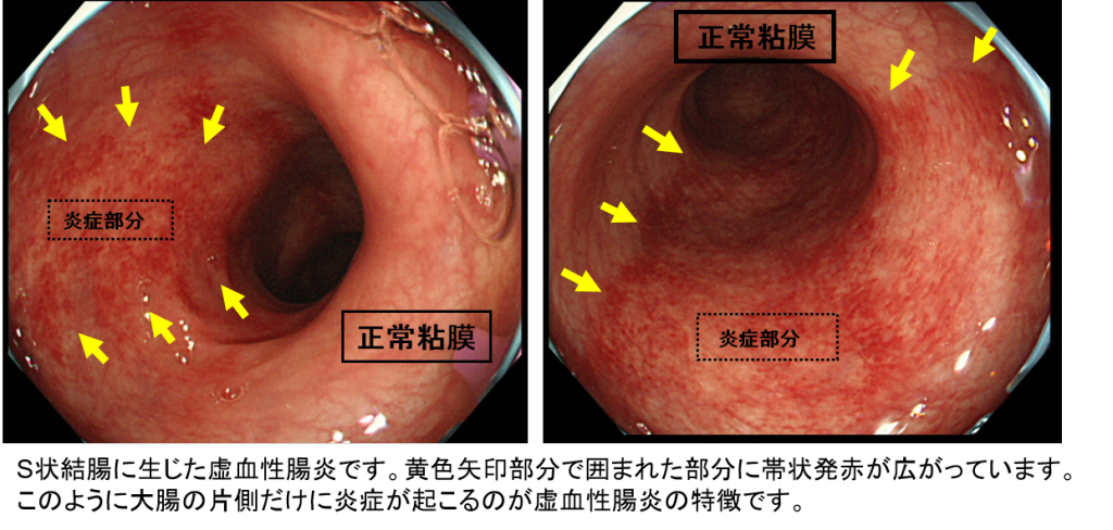 虚血性腸炎 巣鴨駅前胃腸内科クリニック