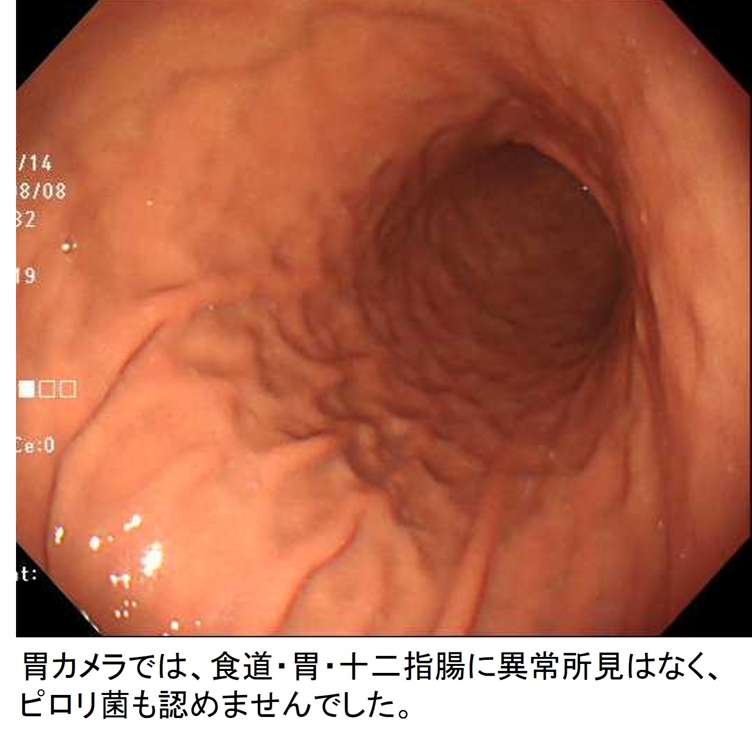 胃の内視鏡画像