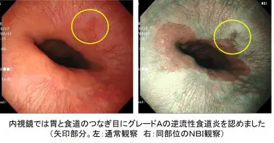 逆流性食道炎の原因と治療・予防法 巣鴨駅前胃腸内科クリニック