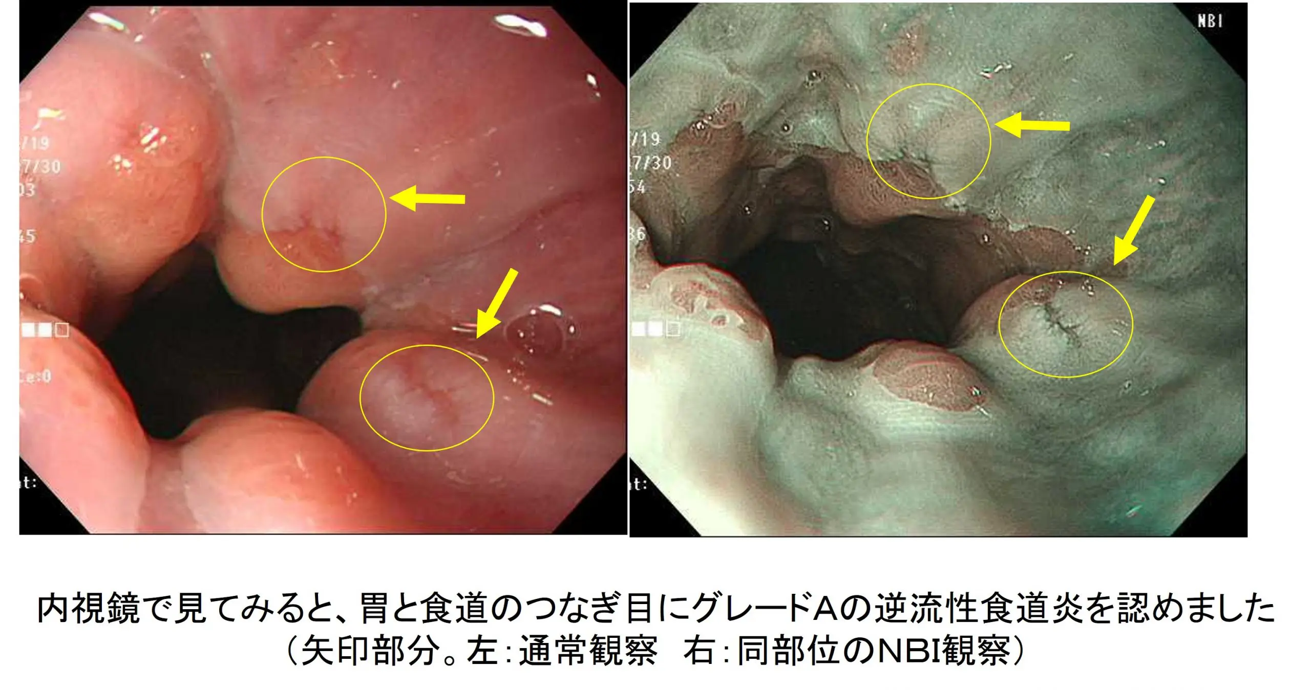 胸やけ外来 逆流性食道炎でお困りの方は当院にご相談ください