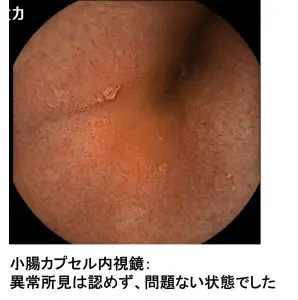 小腸カプセル内視鏡画像