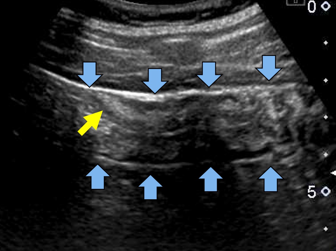 感染性大腸炎と潰瘍性大腸炎はどちらがかかりますか?