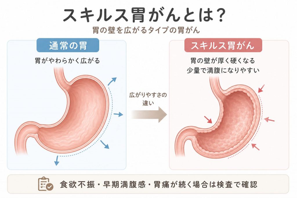 食欲不振・すぐ満腹になる症状は胃がんのことも｜20代女性のスキルス