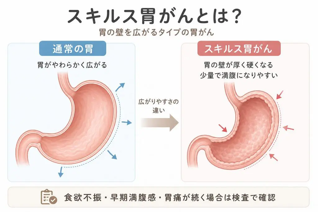 食欲不振・すぐ満腹になる症状は胃がんのことも｜20代女性のスキルス