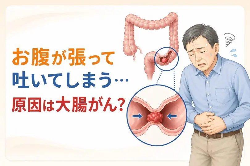お腹の張り・便秘・吐き気で見つかった大腸がんによる腸閉塞の実例