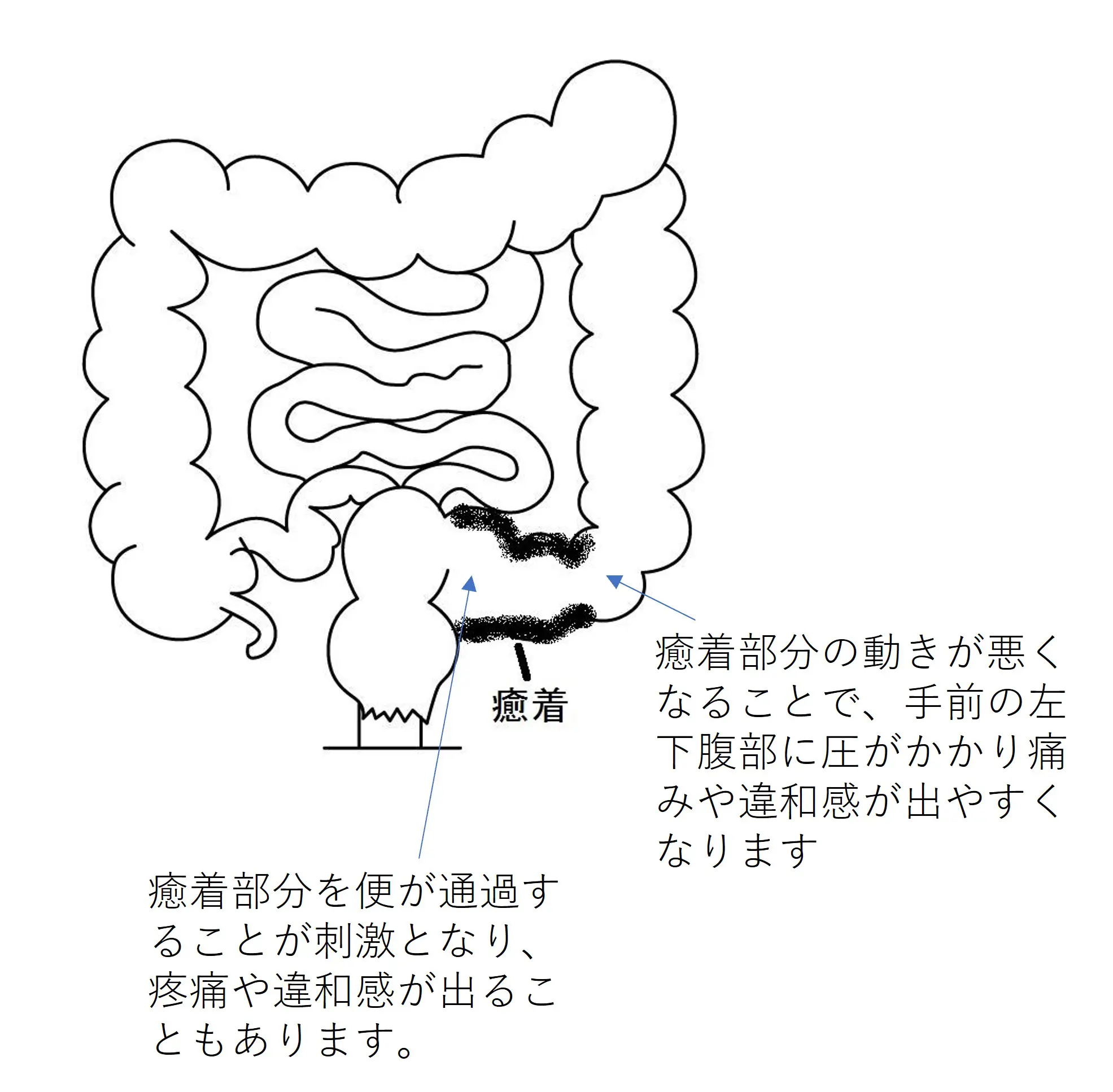 当院での実際の治療例 “みぞおちの左側が痛む（大腸がん）” 巣鴨駅前