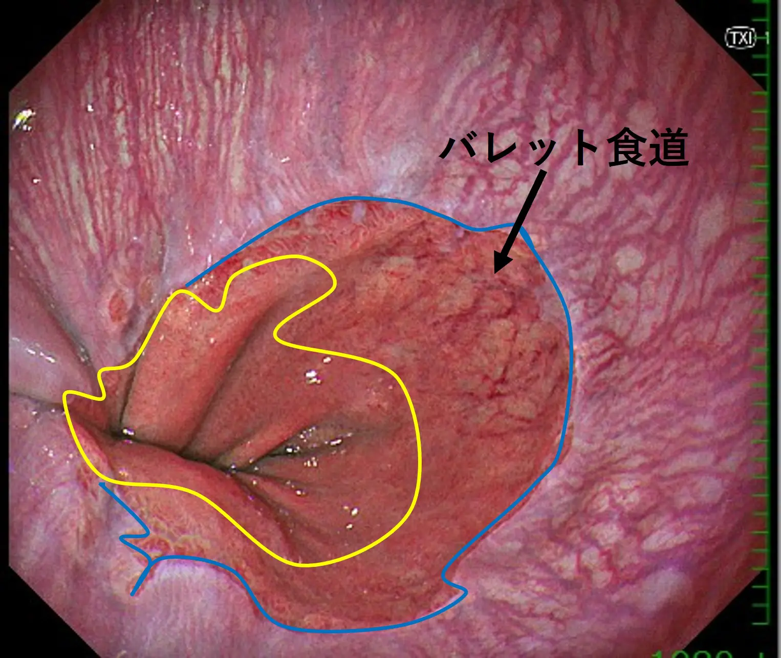バレット 食道 と 言 われ たら