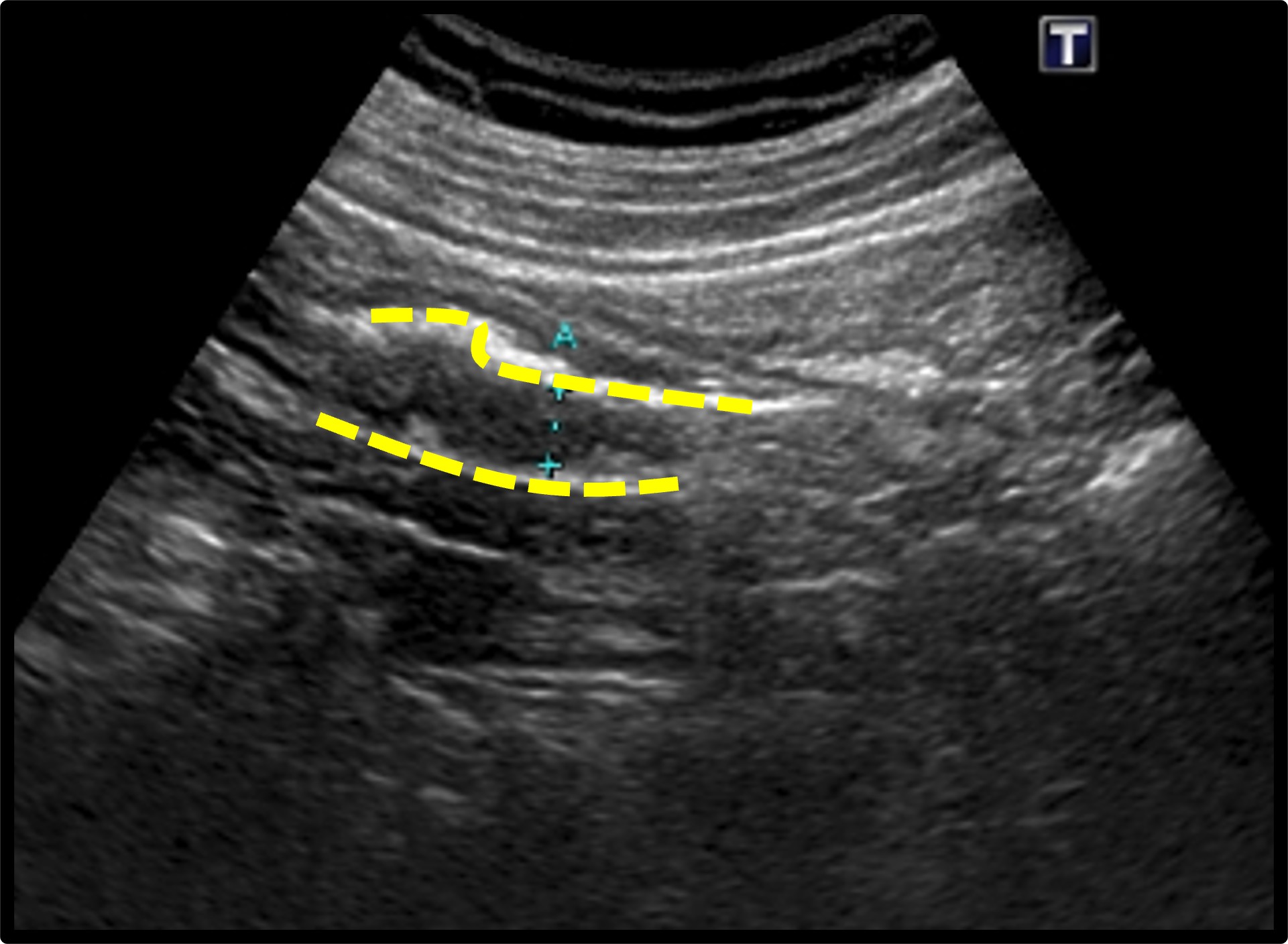 虚血性腸炎のエコー画像