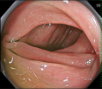 反復性虚血性腸炎