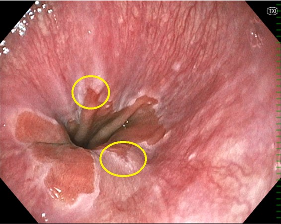 げっぷの原因となった逆流性食道炎｜巣鴨駅前胃腸内科