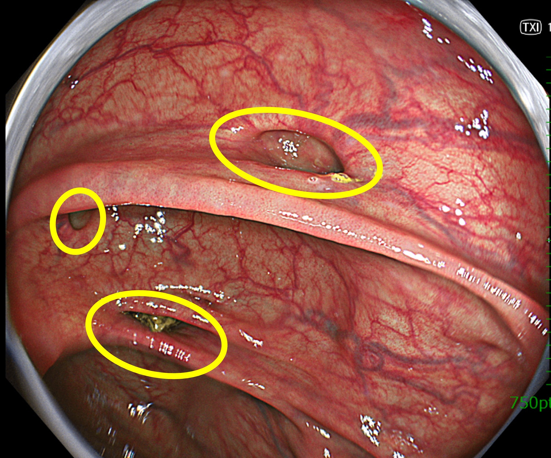 無痛大腸カメラ（内視鏡）で診断した大腸憩室｜巣鴨駅前胃腸内科