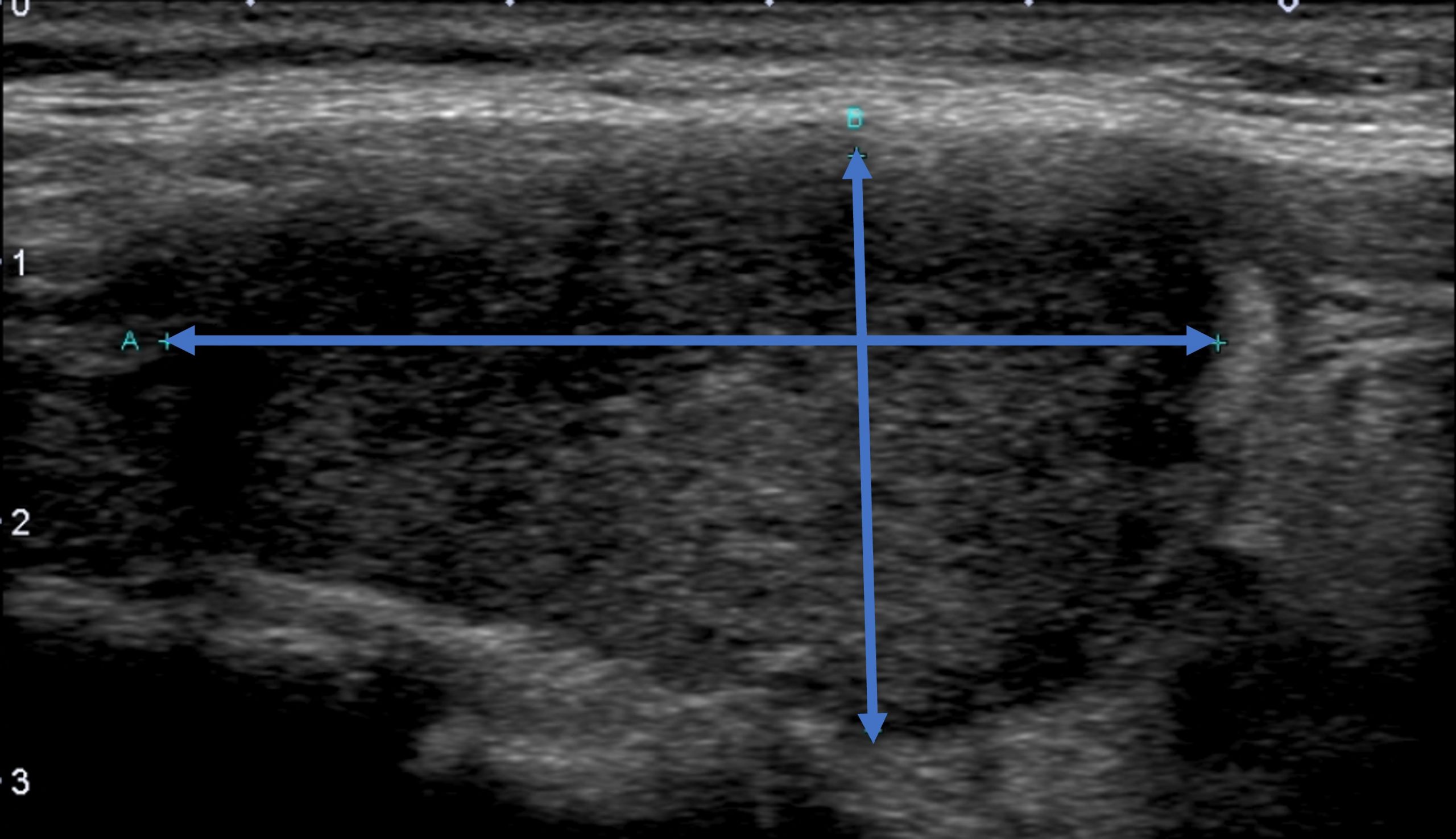 甲状腺炎エコーで判明した甲状腺炎｜のどの違和感の原因