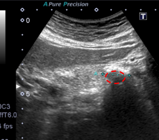 腹部エコーで診断した慢性膵炎｜巣鴨駅前胃腸内科クリニック