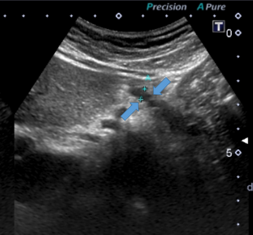 腹部エコーで診断した慢性膵炎｜巣鴨駅前胃腸内科クリニック