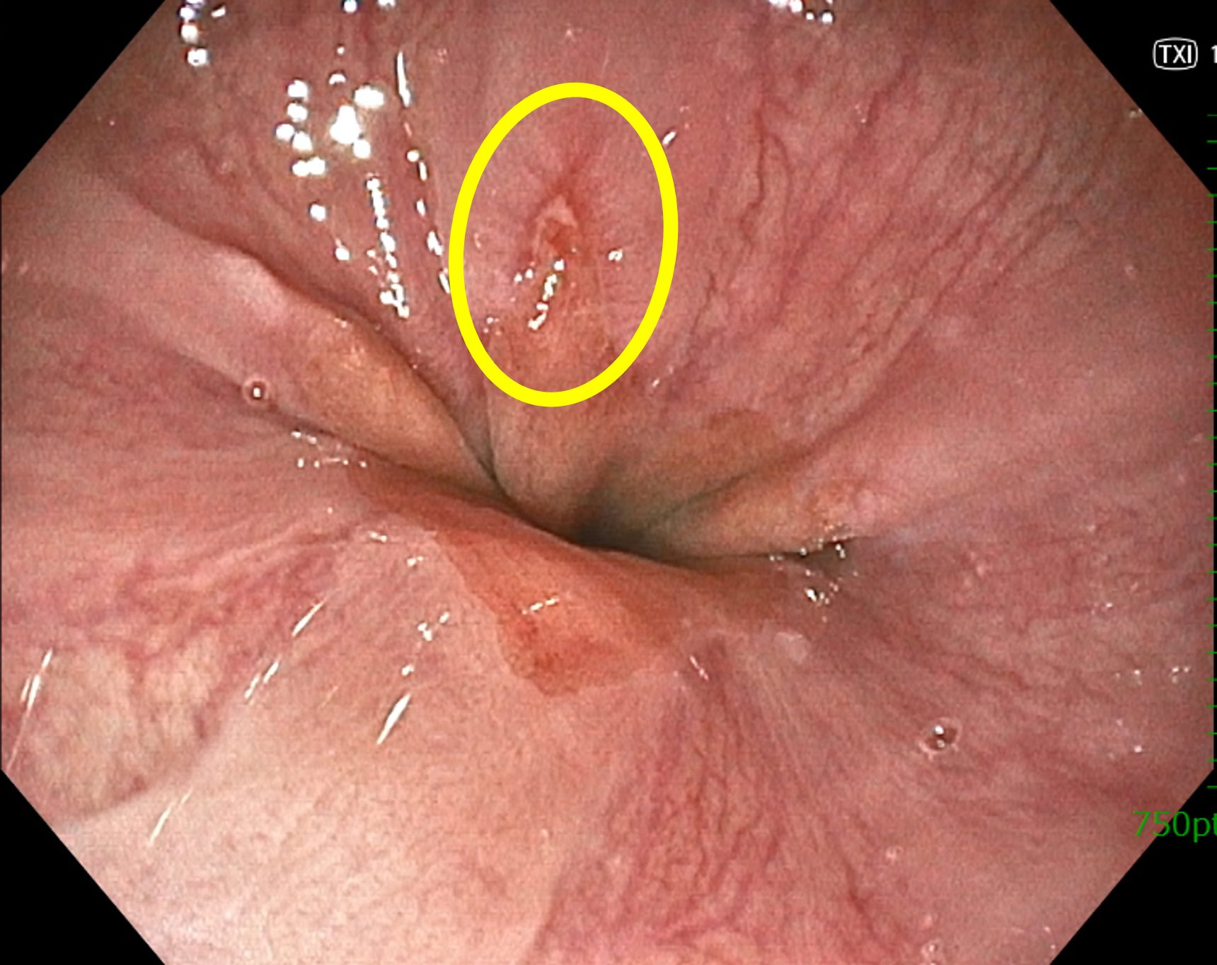 無痛胃カメラ（内視鏡）で診断した逆流性食道炎｜巣鴨駅前胃腸内科