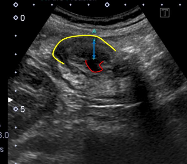 大腸憩室炎｜みぞおちの痛みの原因を腹部エコーで診断した｜｜池袋上田胃腸クリニック