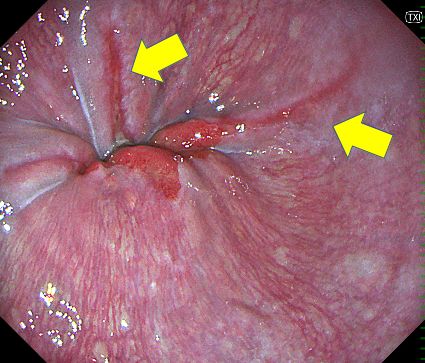 夕食後の胸焼け｜無痛胃カメラで診断した逆流性食道炎｜巣鴨駅前胃腸内科