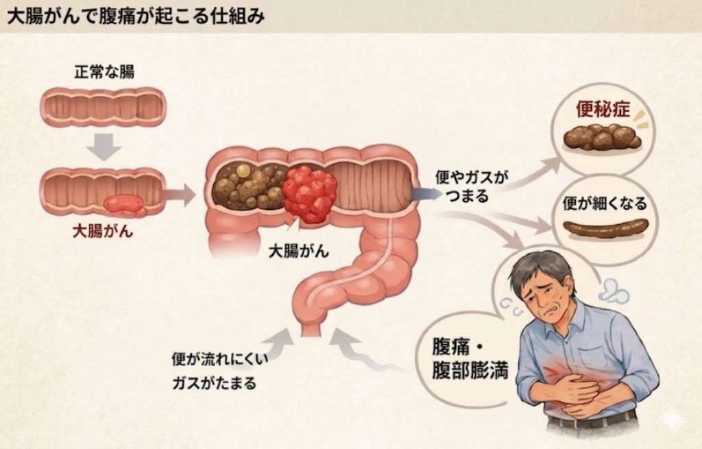 大腸がんが大きくなって腸の内側が狭くなり、便や腸内容物が通りにくくなることで腹痛が起こり、さらに進行すると便秘、腹部膨満、吐き気、腸閉塞につながる流れを示した医療インフォグラフィック