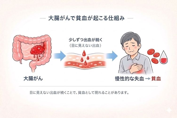 大腸がんの腫瘍から少量の出血が続き、目に見えない出血が蓄積して貧血になる流れを示した医療インフォグラフィック