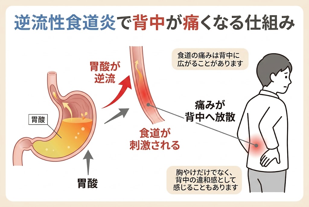 逆流性食道炎で胃酸が食道に逆流し、食道の刺激を介して背中に痛みが放散する仕組みを示した医療インフォグラフィック