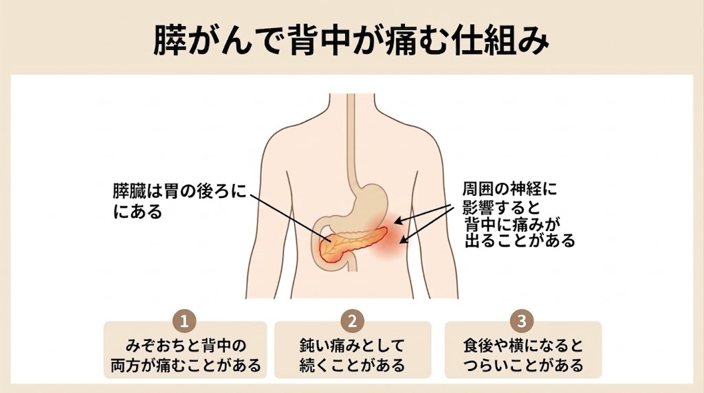 背中の痛みが続くときに膵臓も確認したい理由を示した図。膵臓が胃の後ろで背骨の近くにあり、周囲の神経への影響で背中の痛みが出ることを説明している。